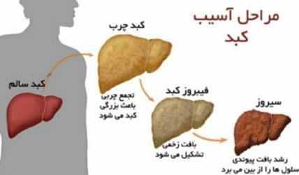  hepatitis - Cirrhosis of the liver(سیروز کبدی - هپاتیت)
