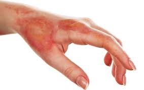 پاورپوینت پاتوفیزیولوژی سوختگی